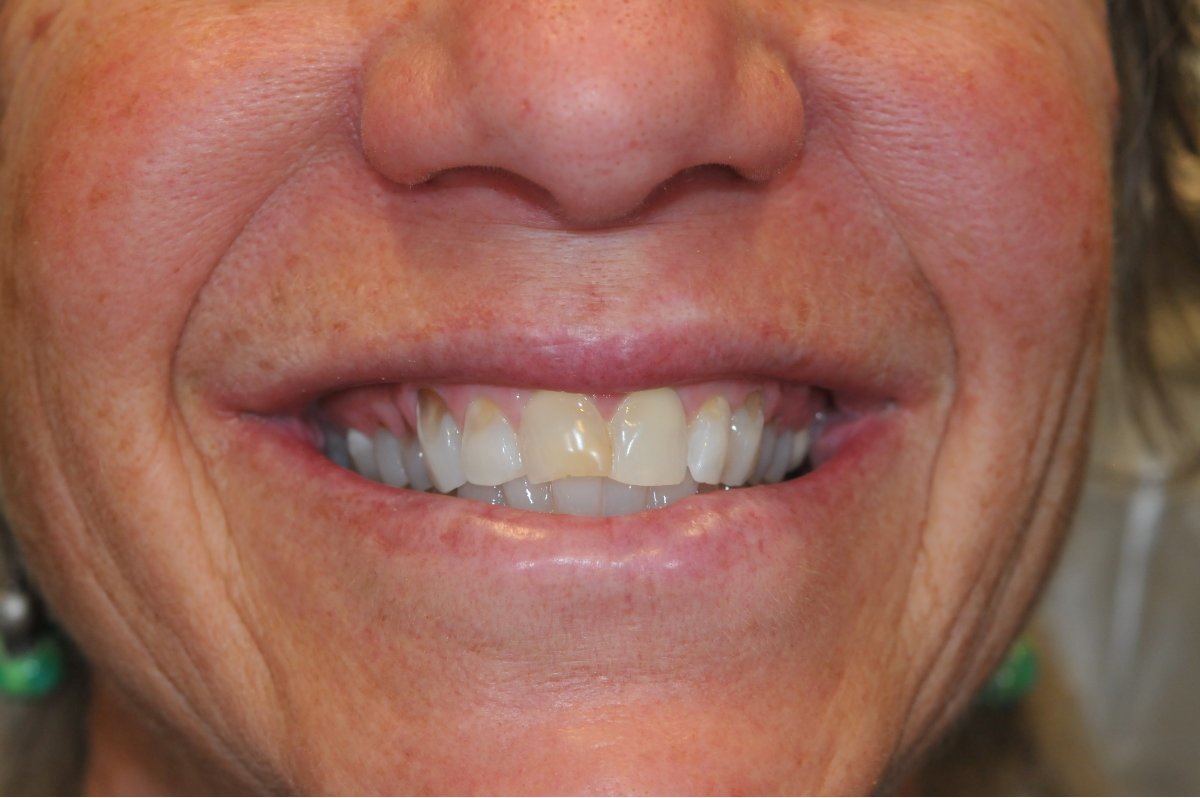 Before and after smiles at Alleman Family Dental Boulder, CO